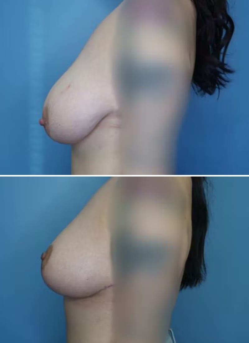 Before and After Image: Breast Lift - left-side