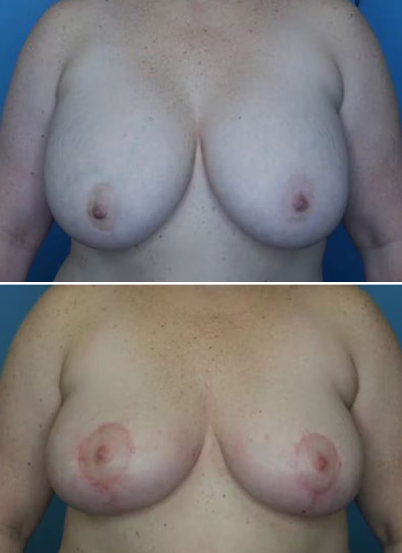 Before and After Image: Breast Lift - front