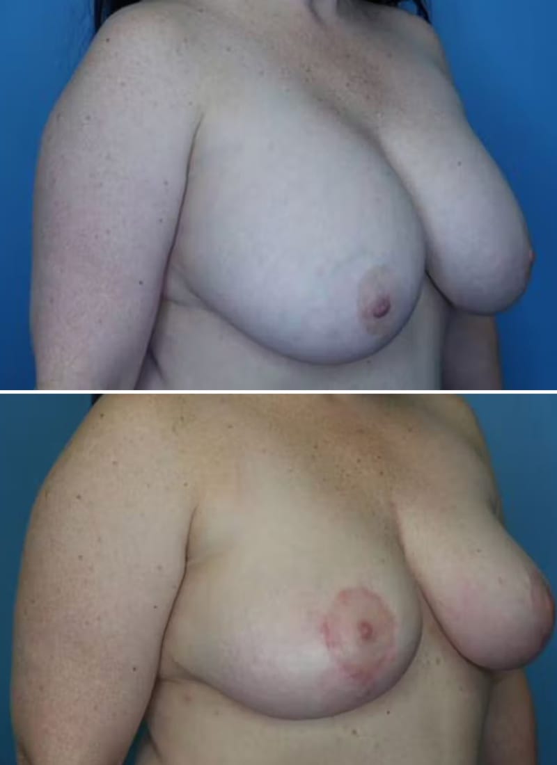 Before and After Image: Breast Lift - right-front-oblique