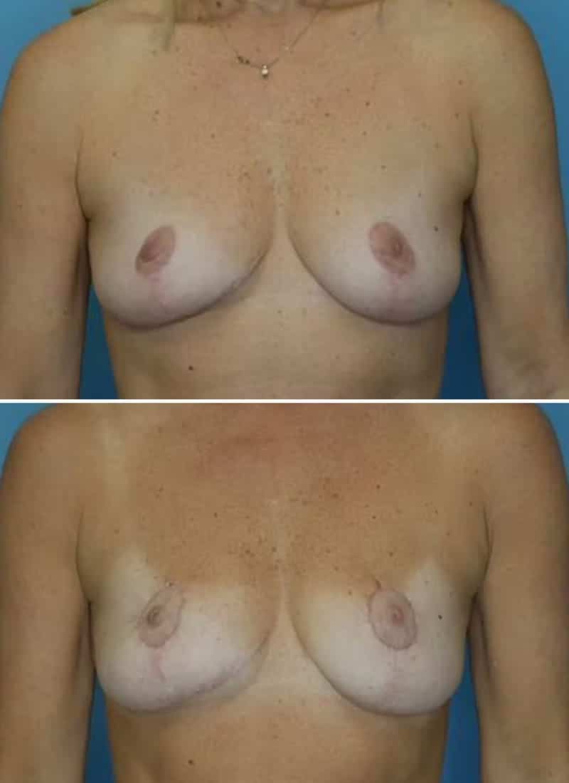 Before and After Image: Breast Lift - front