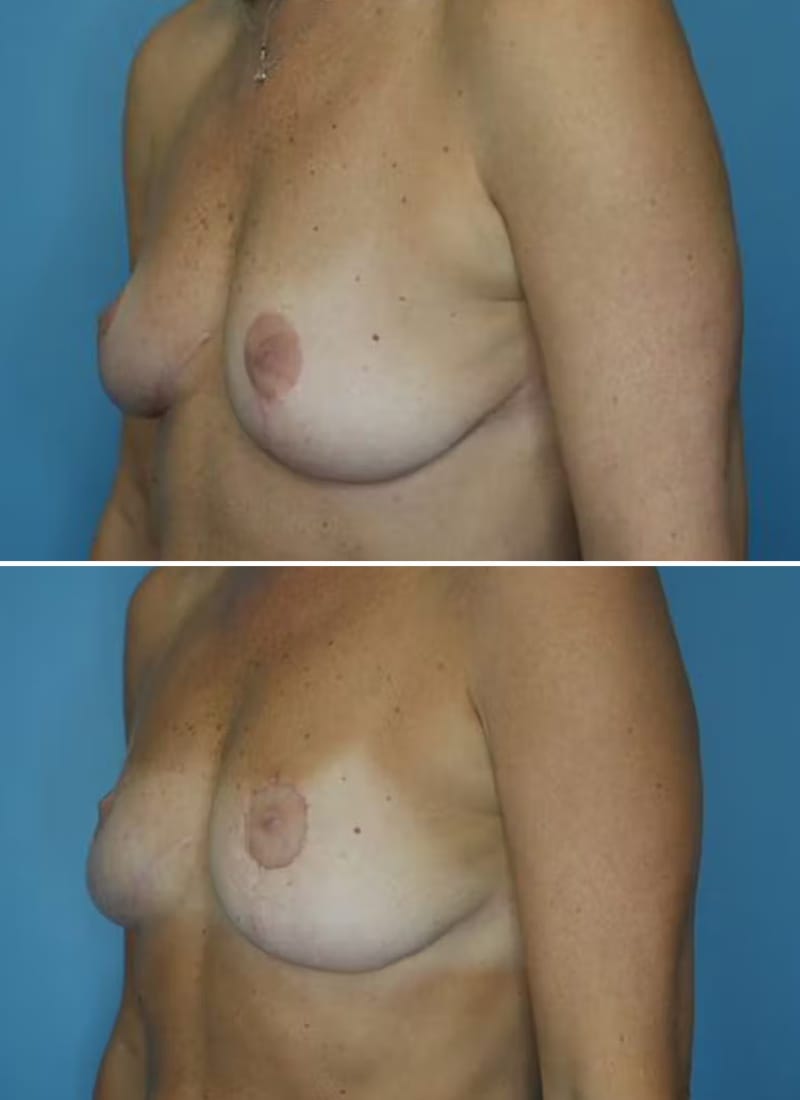 Before and After Image: Breast Lift - left-front-oblique