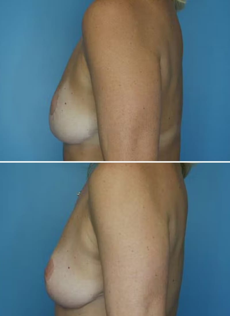 Before and After Image: Breast Lift - left-side