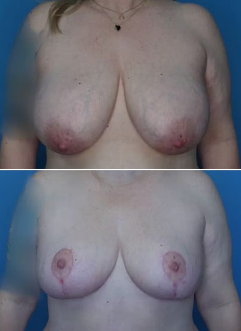 Before and After Image: Breast Lift - front