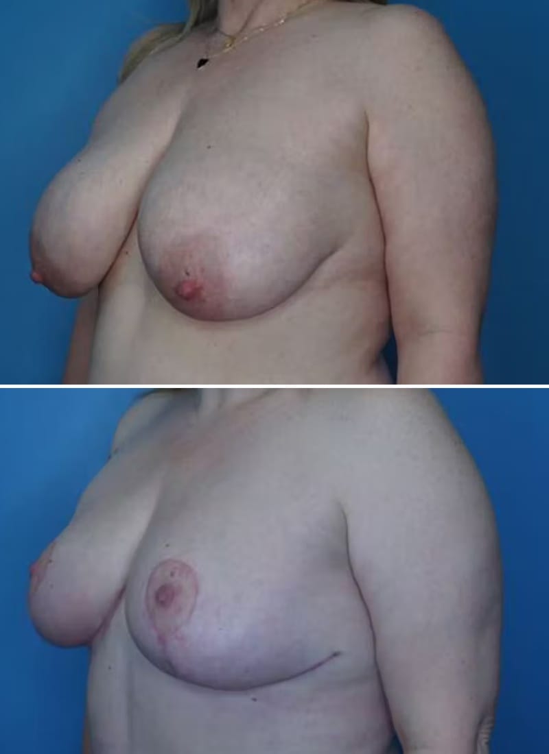 Before and After Image: Breast Lift - left-front-oblique