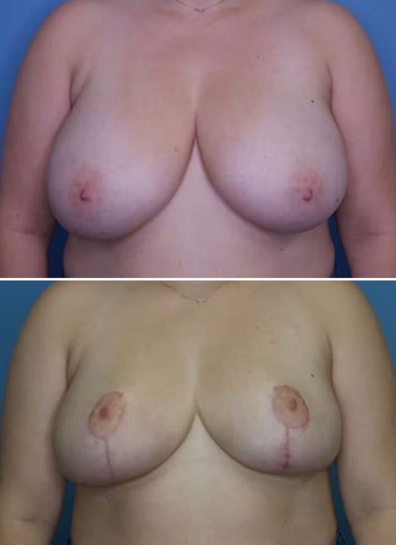 Before and After Image: Breast Lift - front