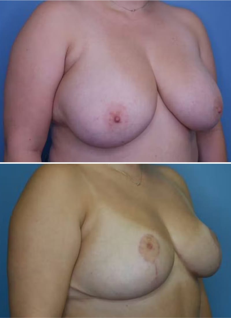 Before and After Image: Breast Lift - right-front-oblique