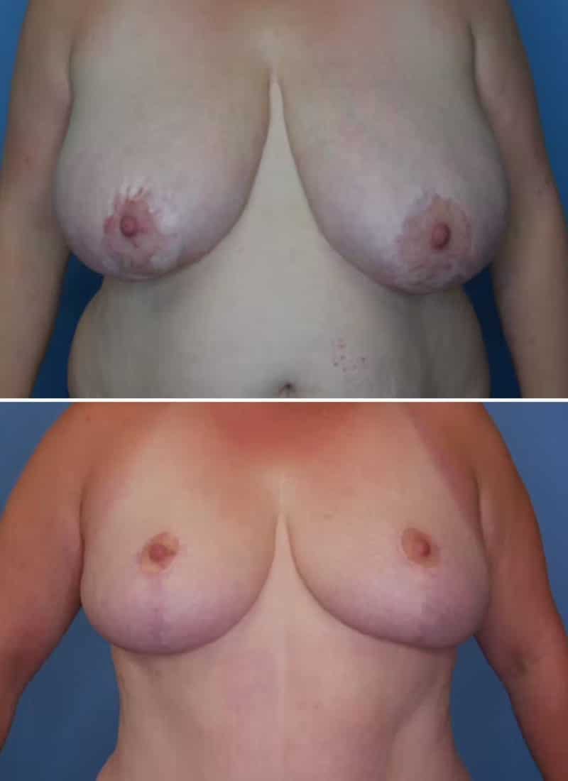 Before and After Image: Breast Lift - front