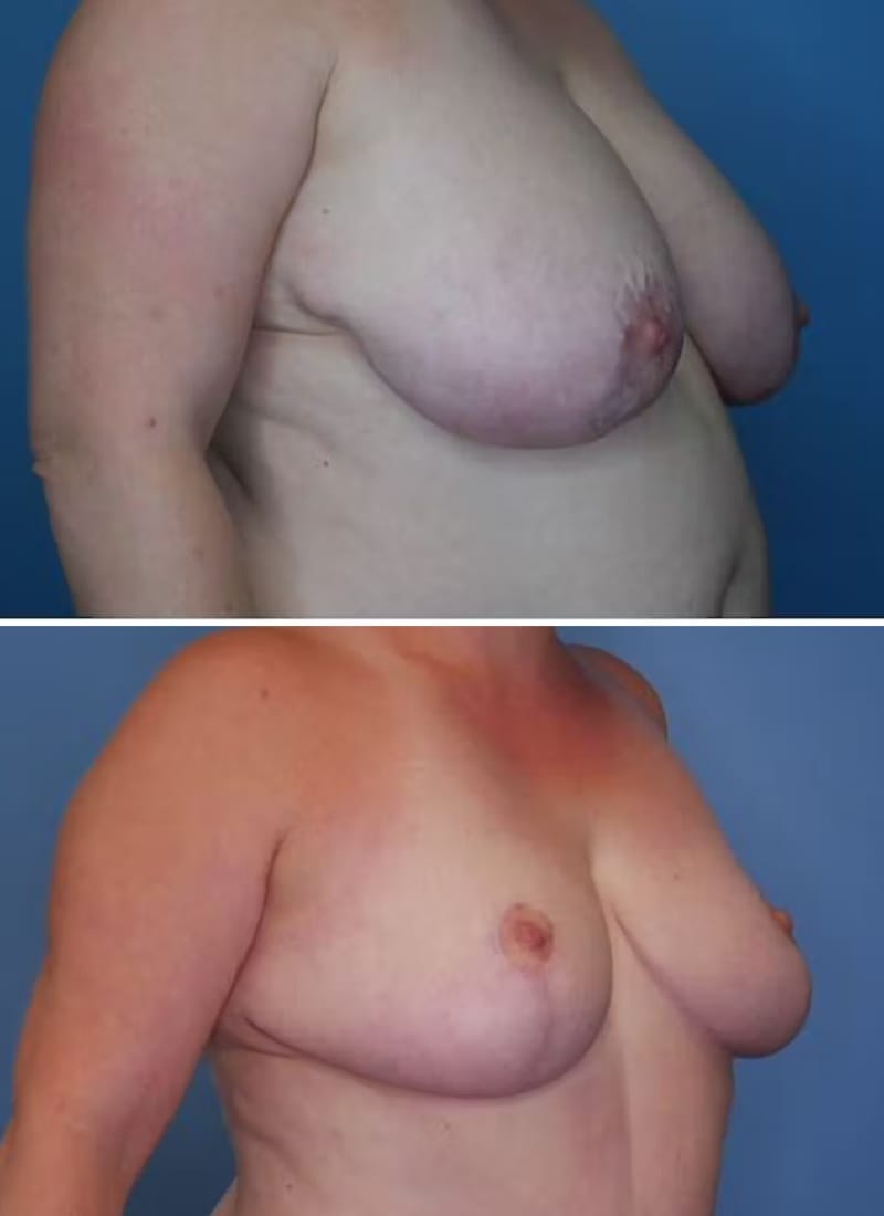 Before and After Image: Breast Lift - right-front-oblique