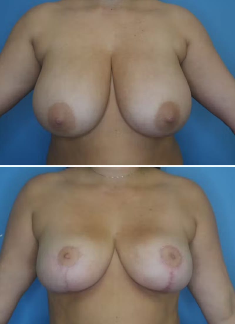 Before and After Image: Breast Lift - front