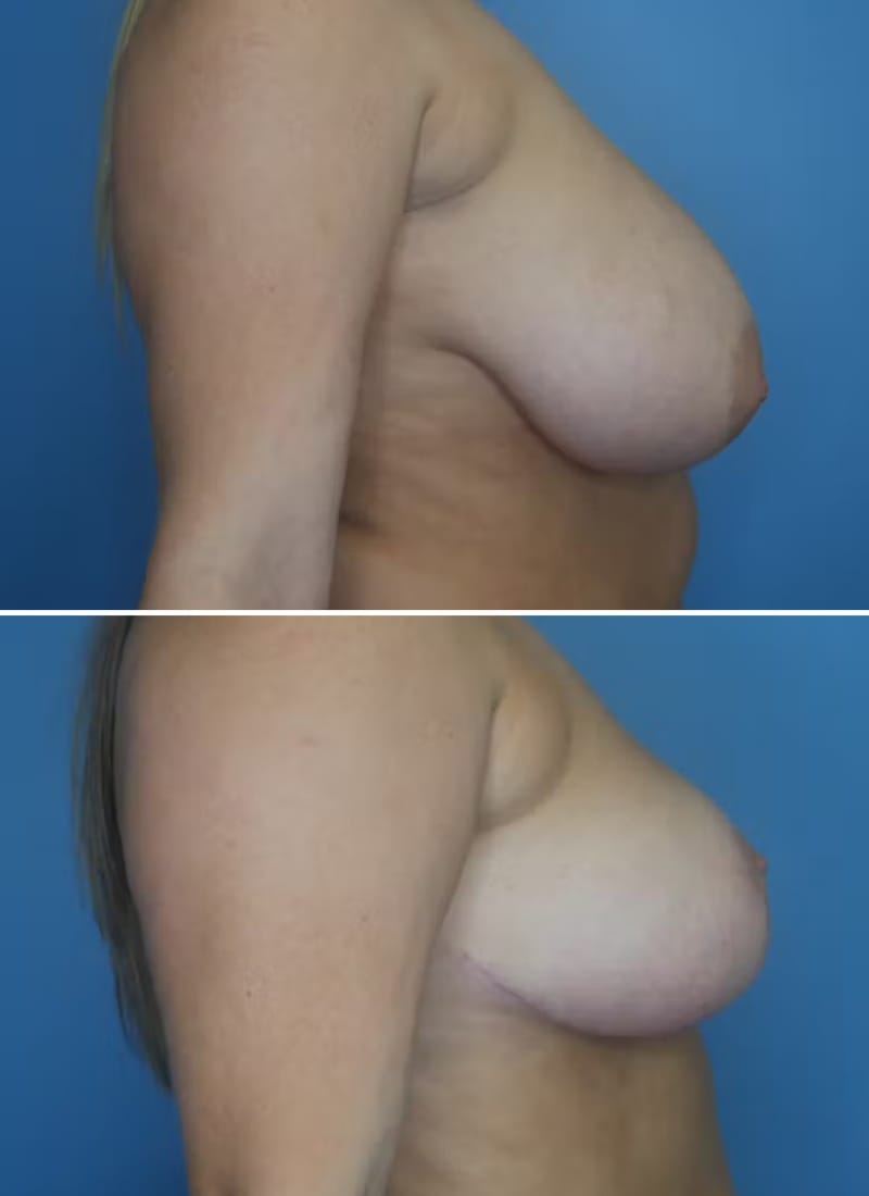 Before and After Image: Breast Lift - right-side