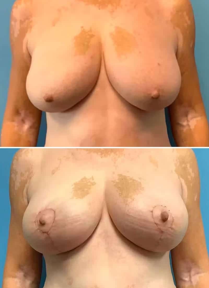 Before and After Image: Breast Lift - front