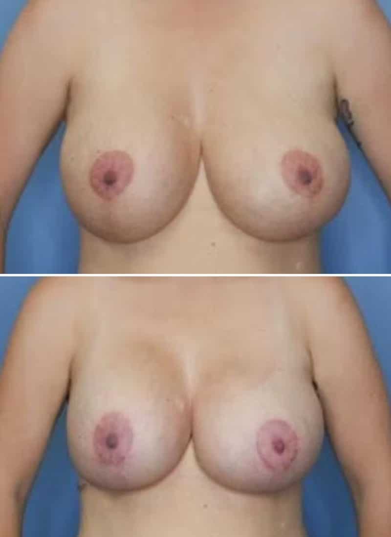 Before and After Image: Breast Lift - front