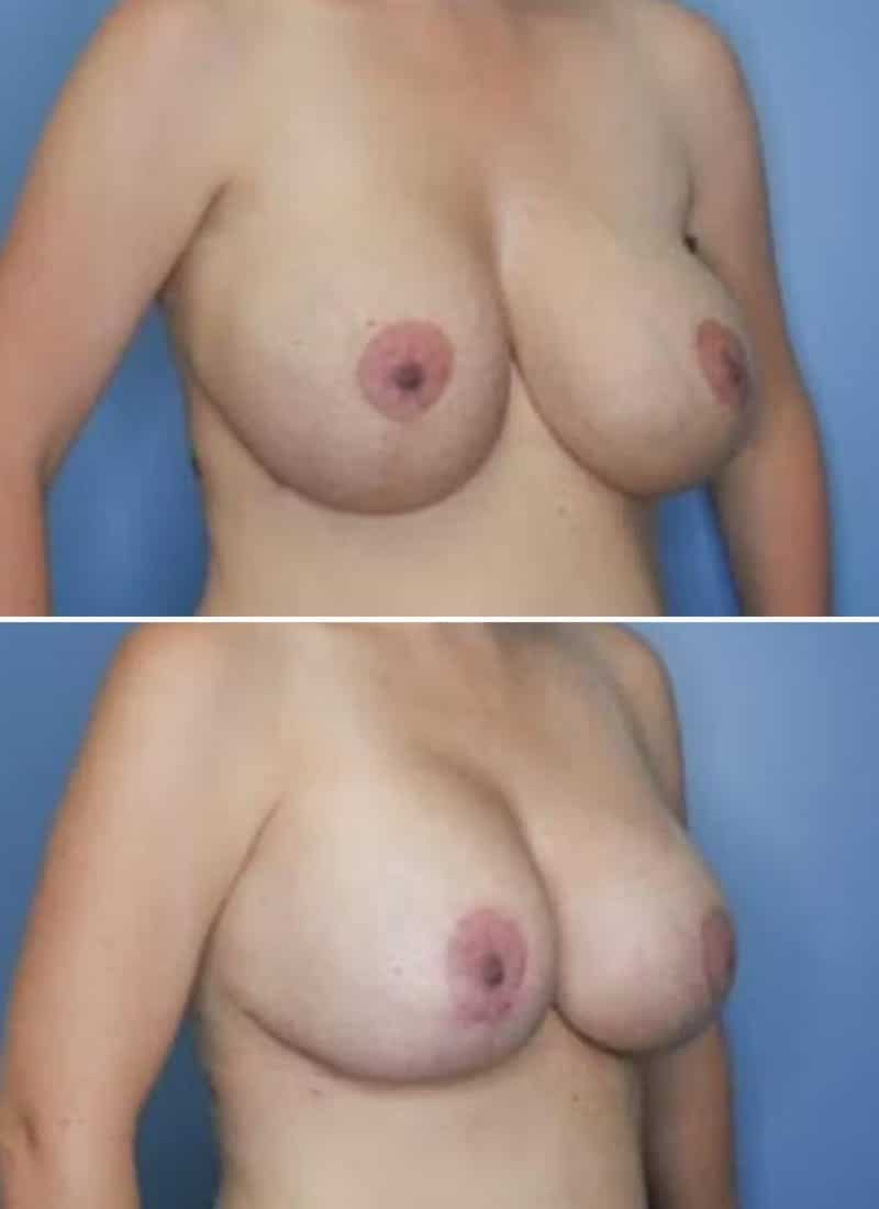 Before and After Image: Breast Lift - right-front-oblique