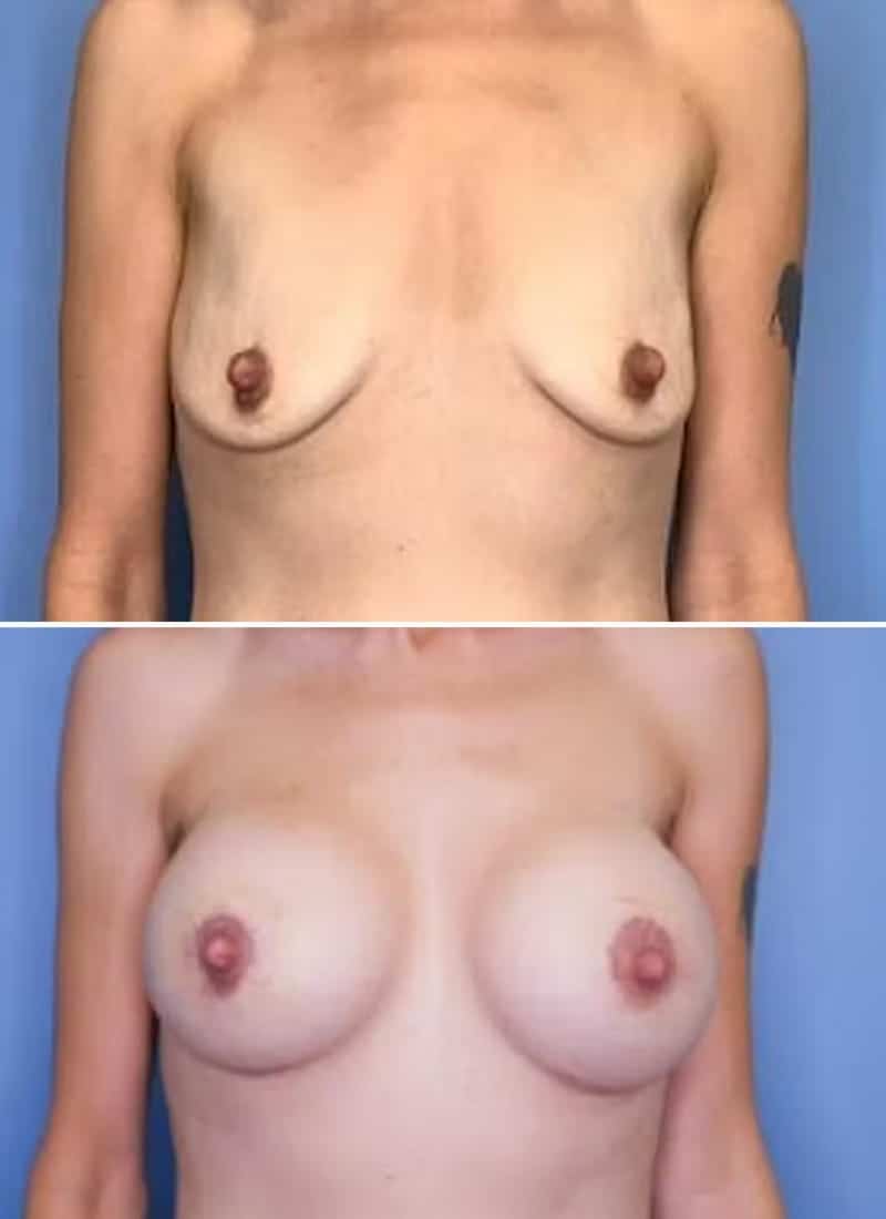 Before and After Image: Breast Lift - front