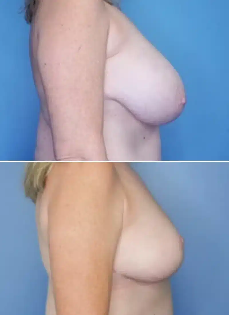 Before and After Image: Breast Lift - right-side