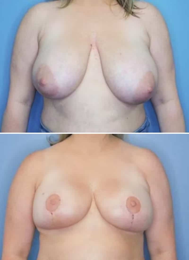 Before and After Image: Breast Lift - front