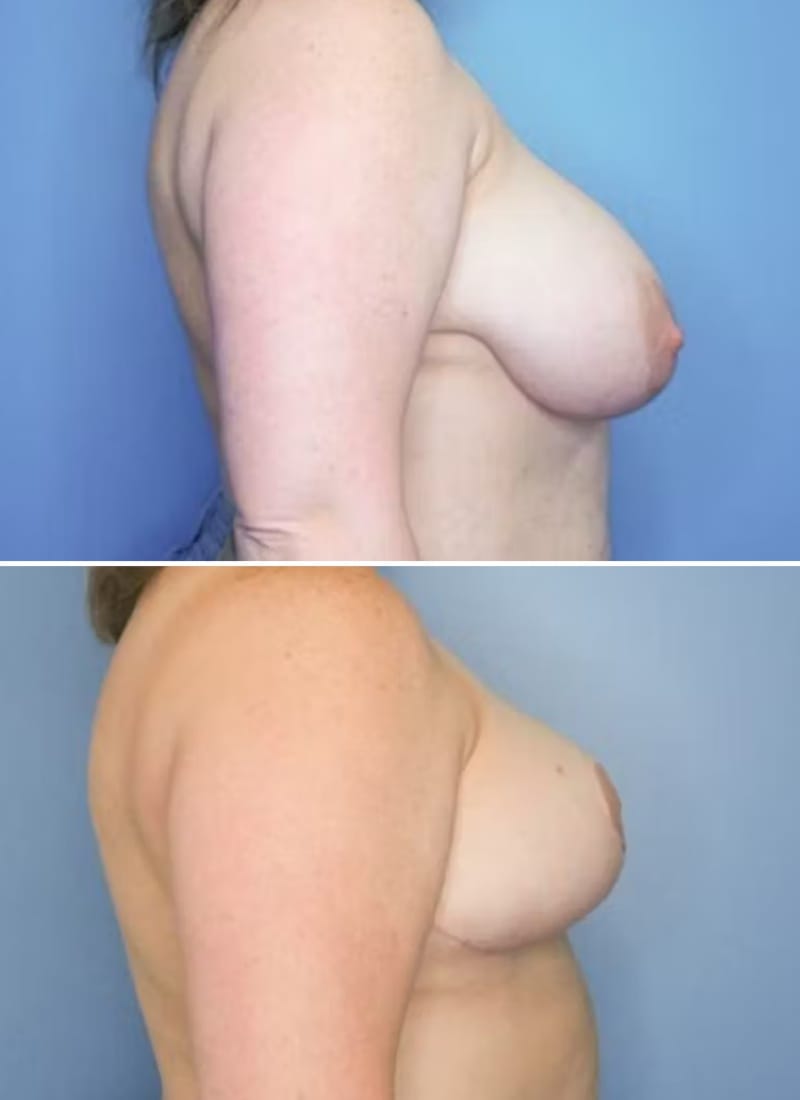 Before and After Image: Breast Lift - right-side