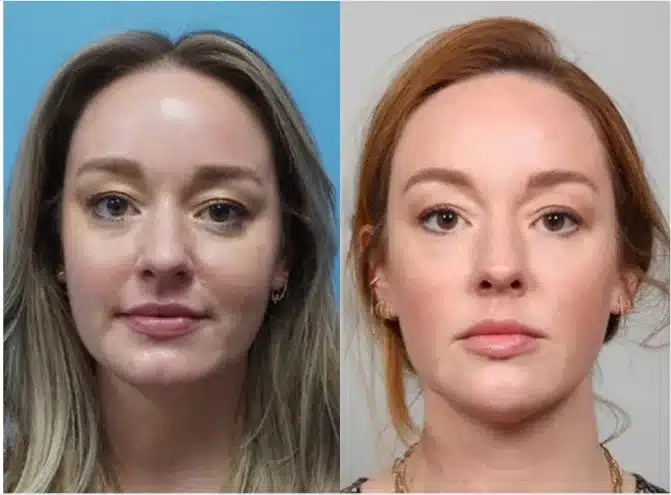 Before and After Image: BOTOX/Dysport - front