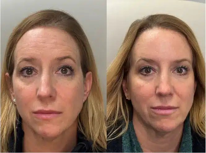 Before and After Image: BOTOX/Dysport - front