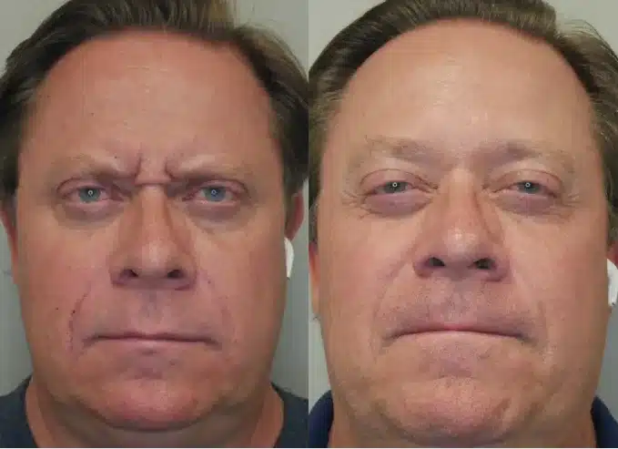 Before and After Image: BOTOX/Dysport - front