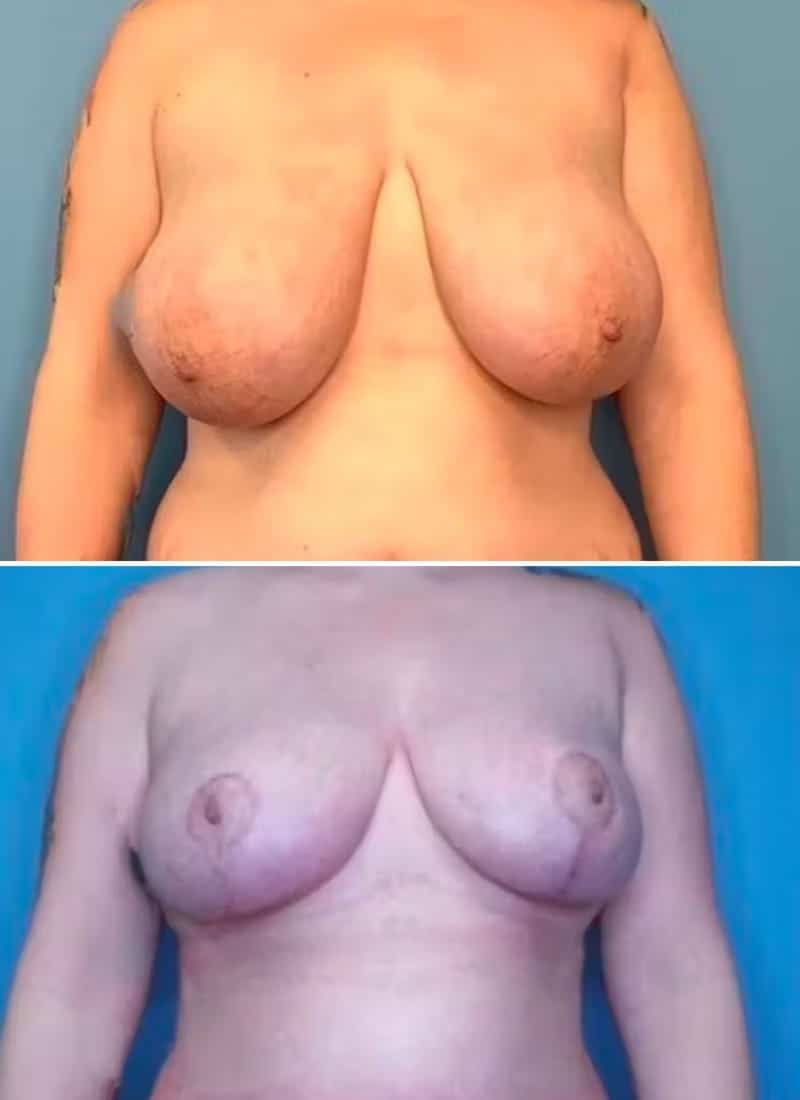 Before and After Image: Breast Reduction - front