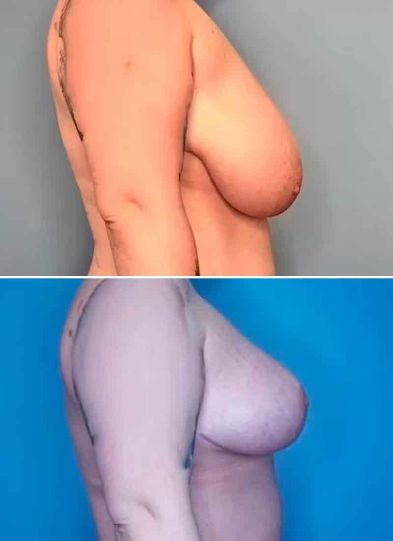 Before and After Image: Breast Reduction - right-side
