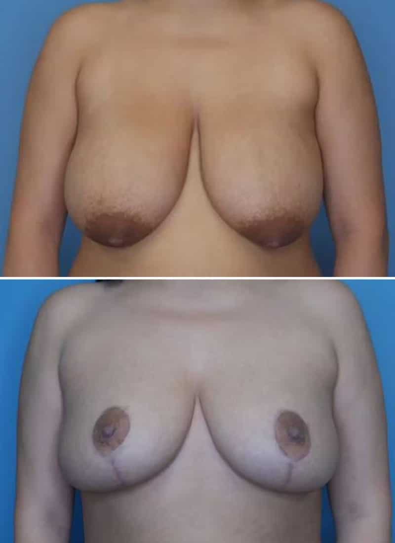 Before and After Image: Breast Reduction - front