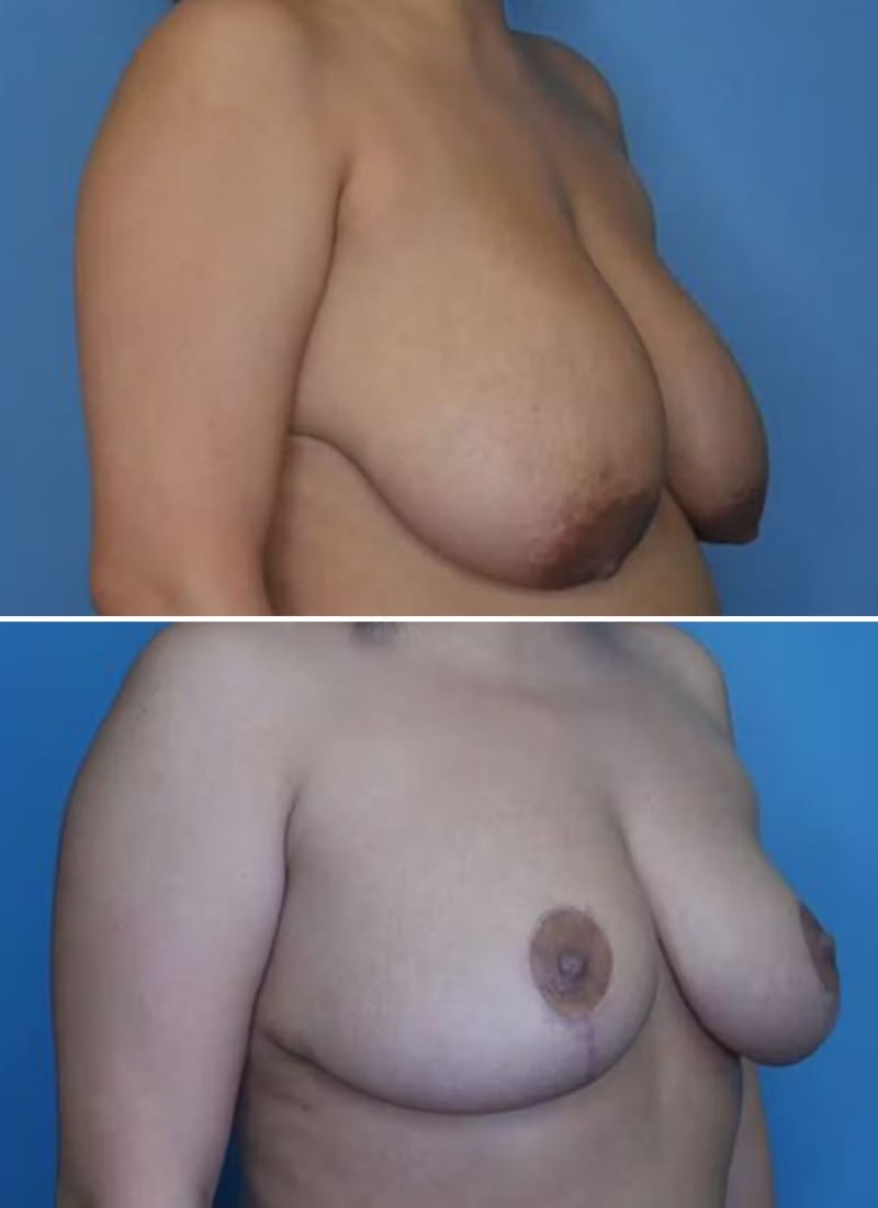 Before and After Image: Breast Reduction - right-front-oblique