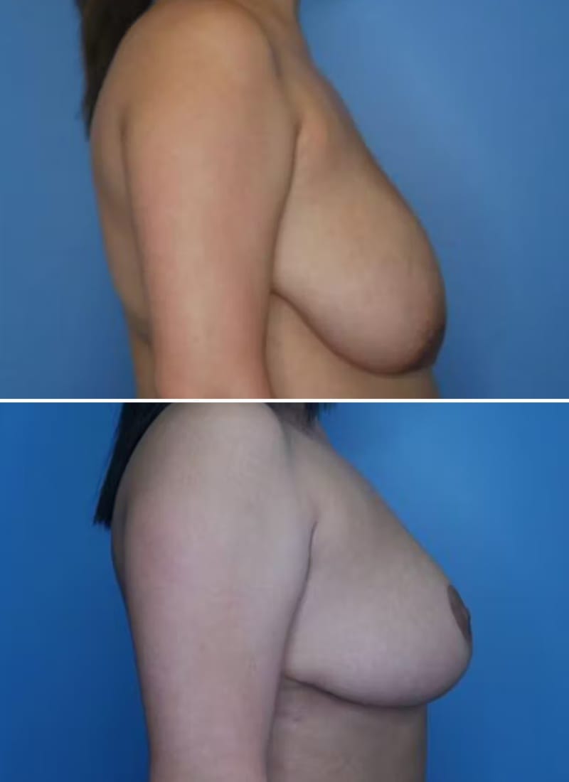 Before and After Image: Breast Reduction - right-side