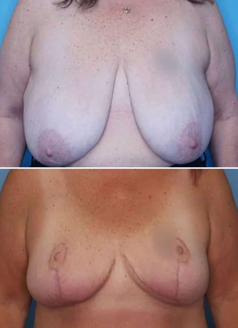 Before and After Image: Breast Reduction - front