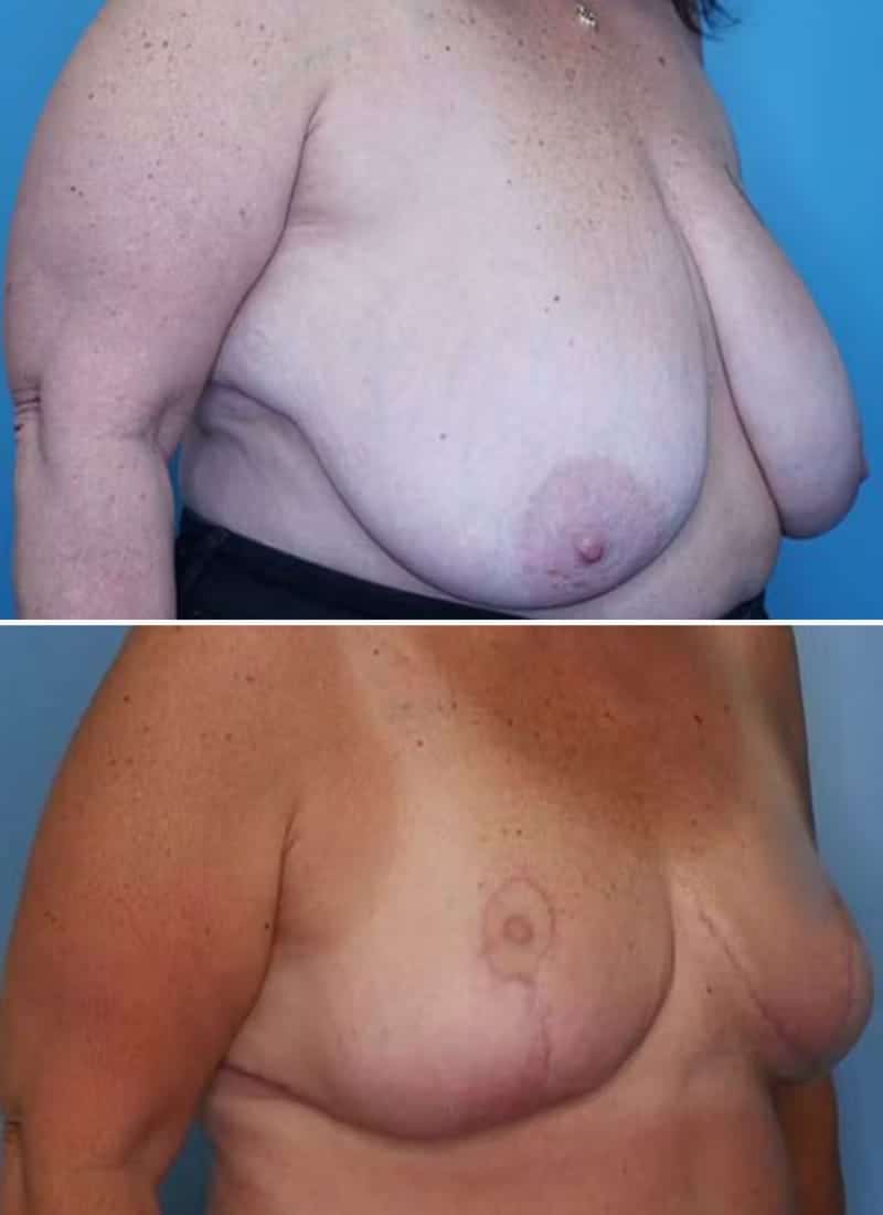 Before and After Image: Breast Reduction - right-front-oblique