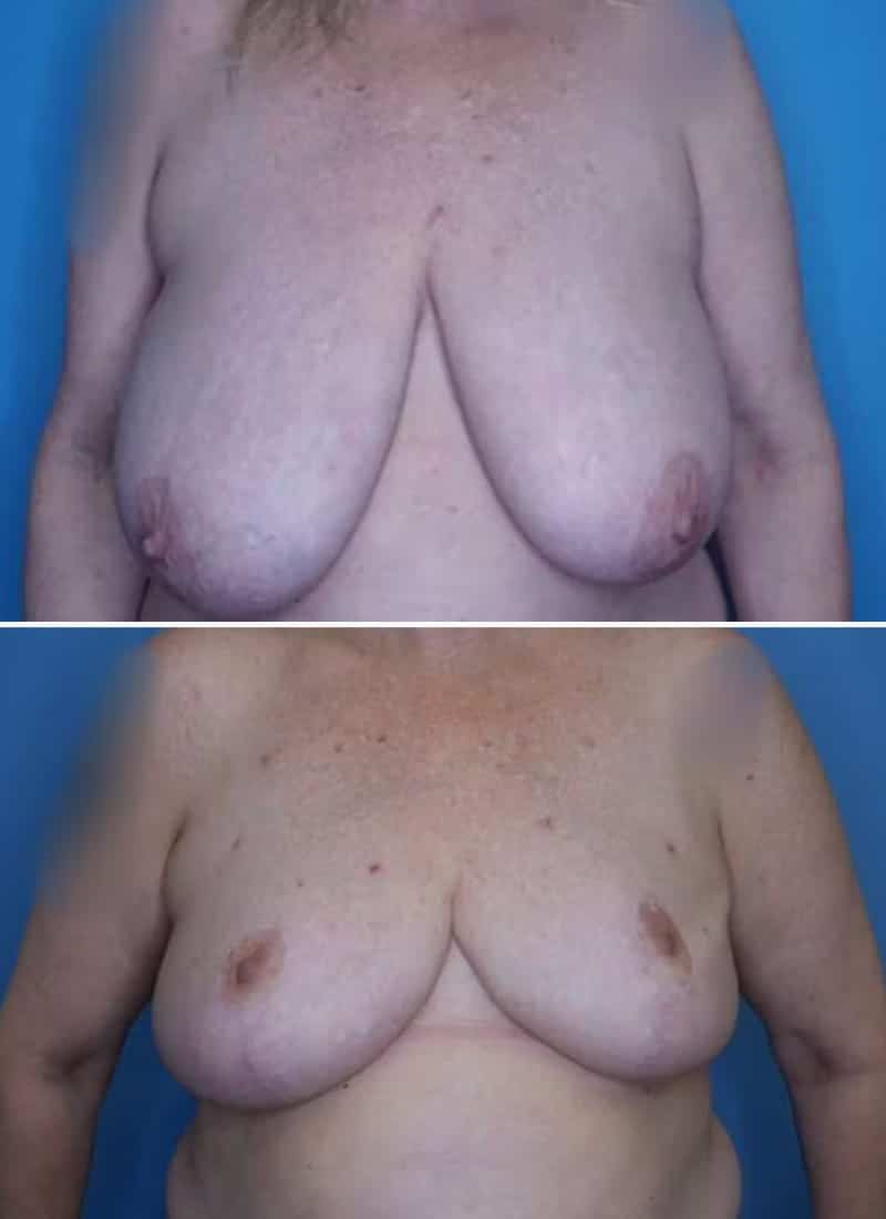 Before and After Image: Breast Reduction - front