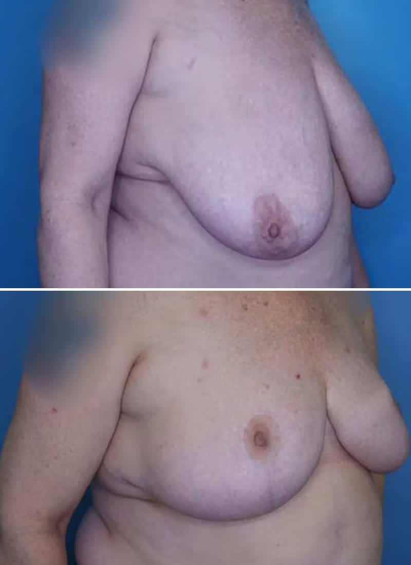 Before and After Image: Breast Reduction - right-front-oblique