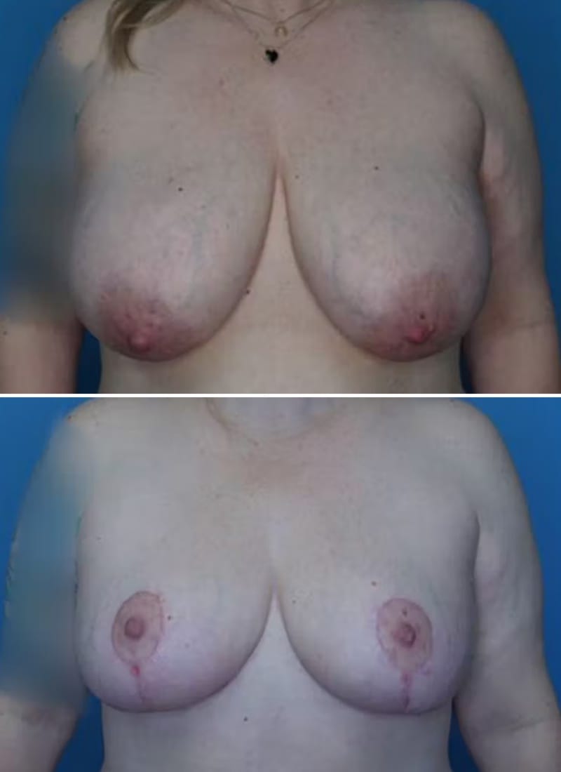 Before and After Image: Breast Reduction - front