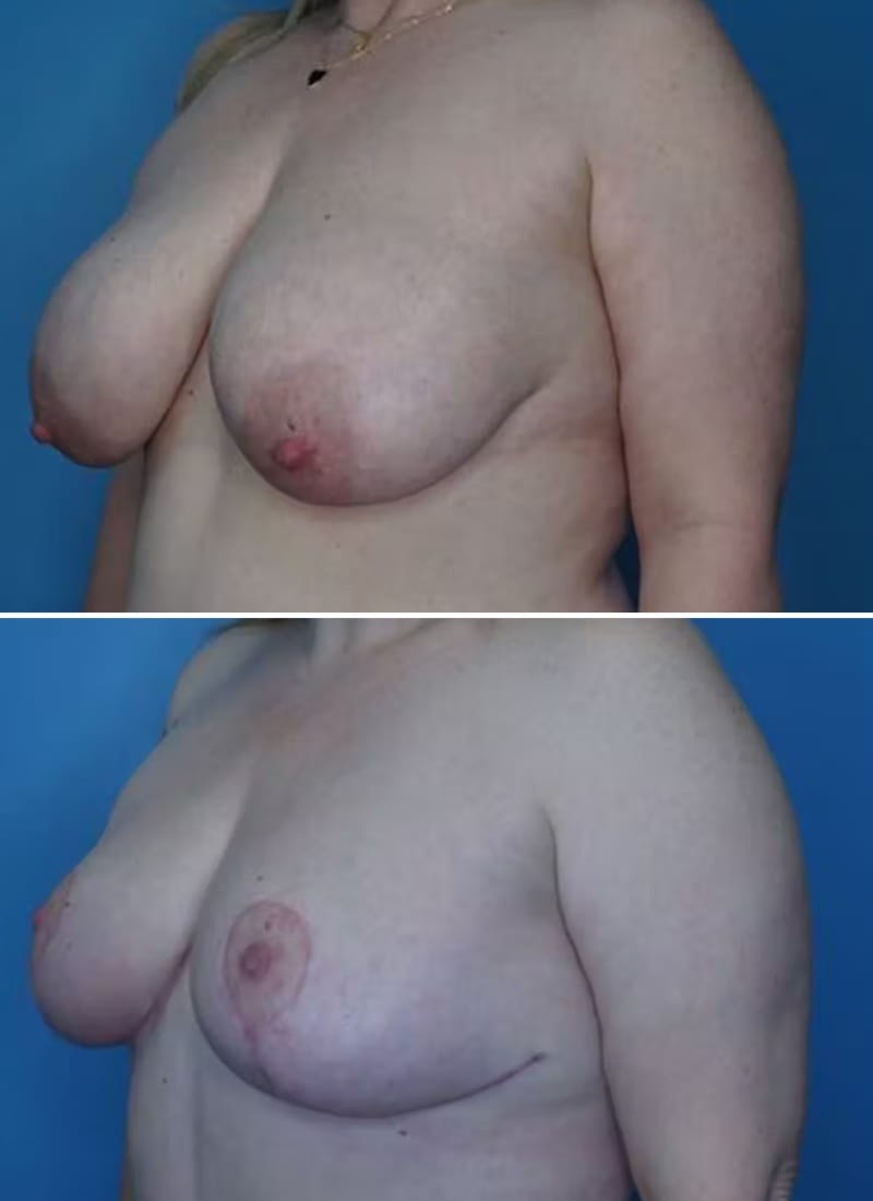 Before and After Image: Breast Reduction - left-front-oblique