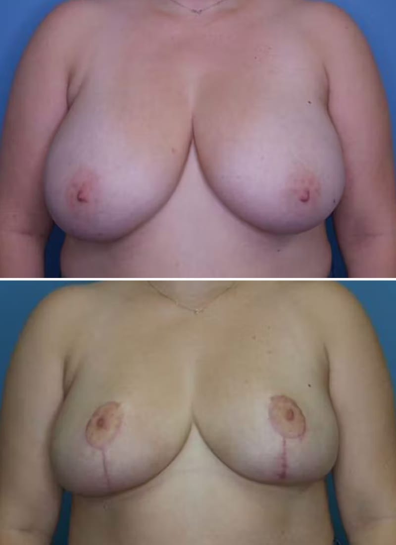 Before and After Image: Breast Reduction - front