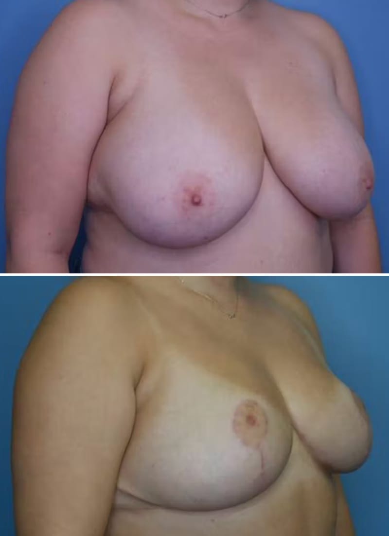 Before and After Image: Breast Reduction - right-front-oblique
