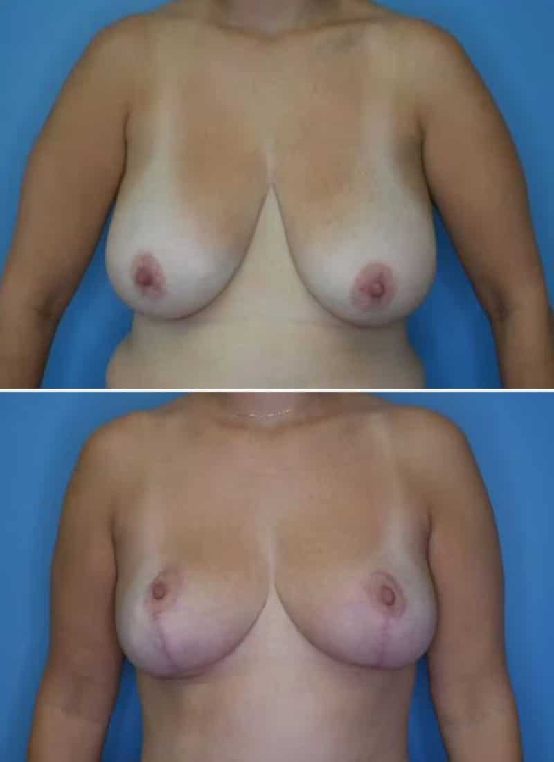 Before and After Image: Breast Reduction - front