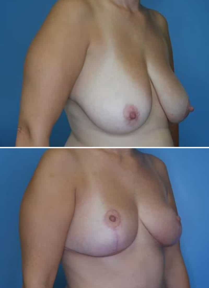 Before and After Image: Breast Reduction - right-front-oblique