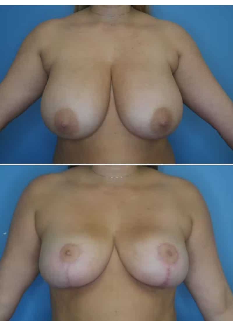 Before and After Image: Breast Reduction - front