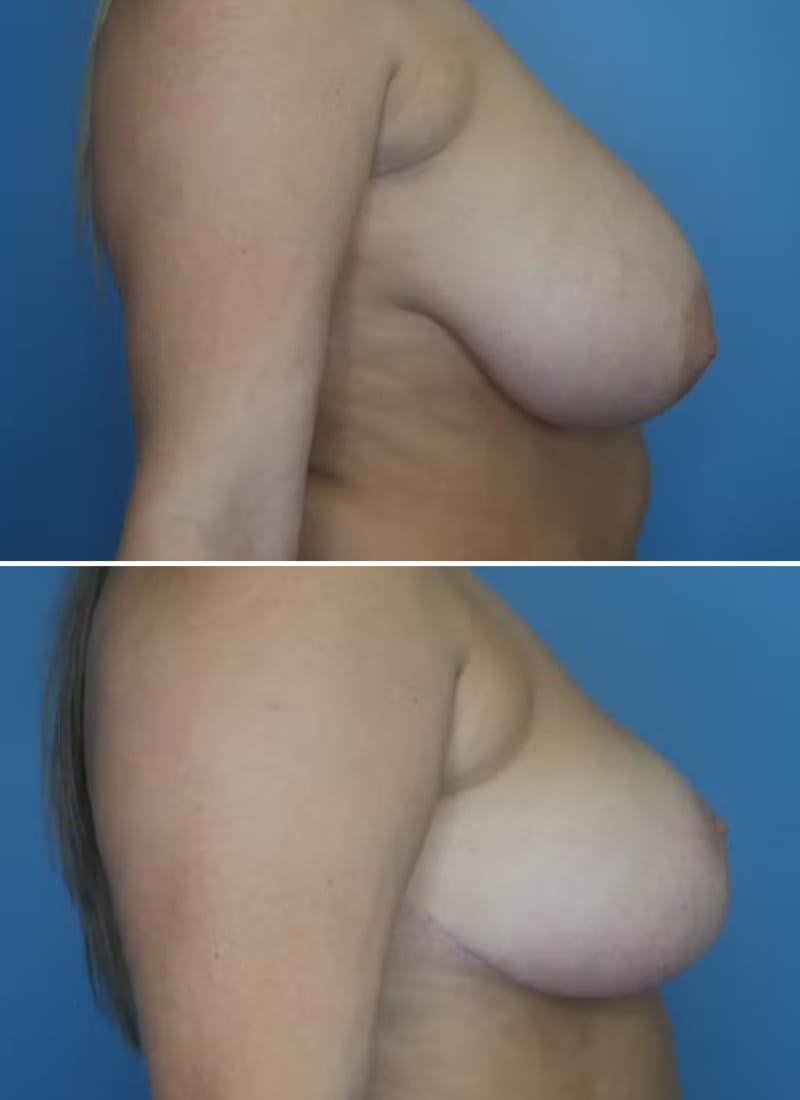 Before and After Image: Breast Reduction - right-side