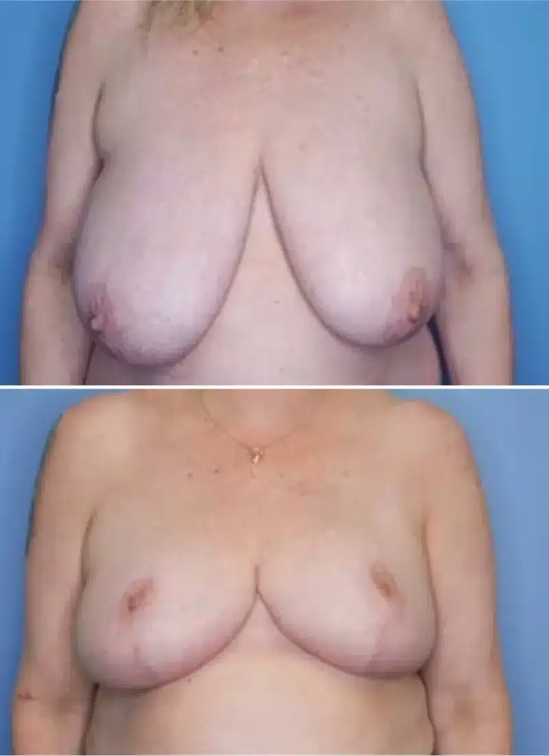Before and After Image: Breast Reduction - front