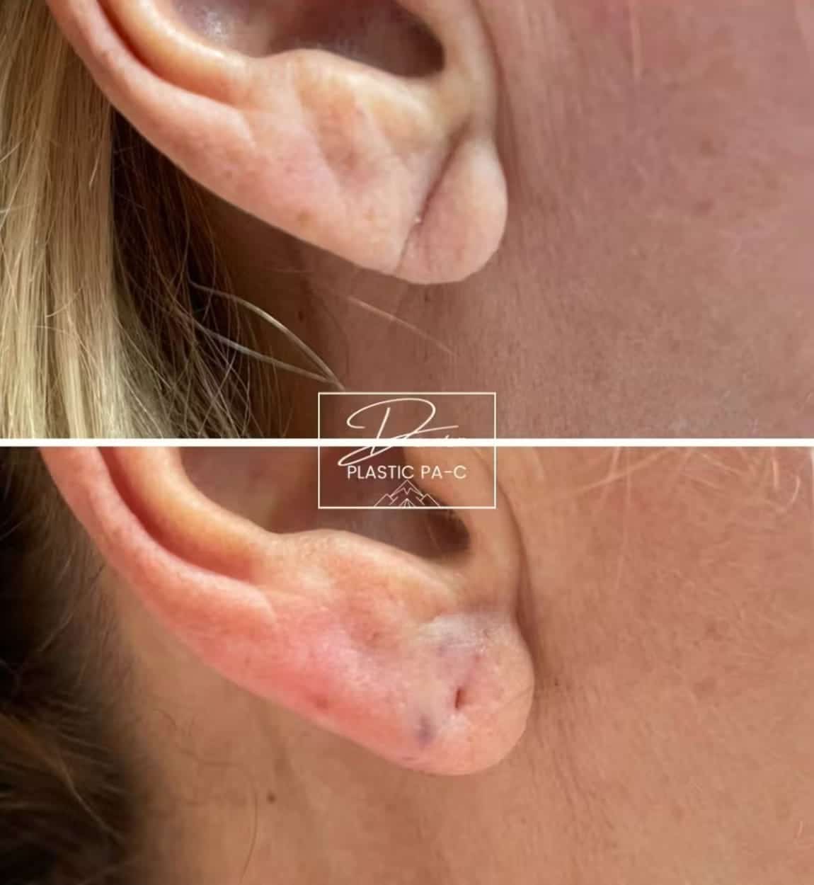 Before and After Image: Earlobe Repair - right-side