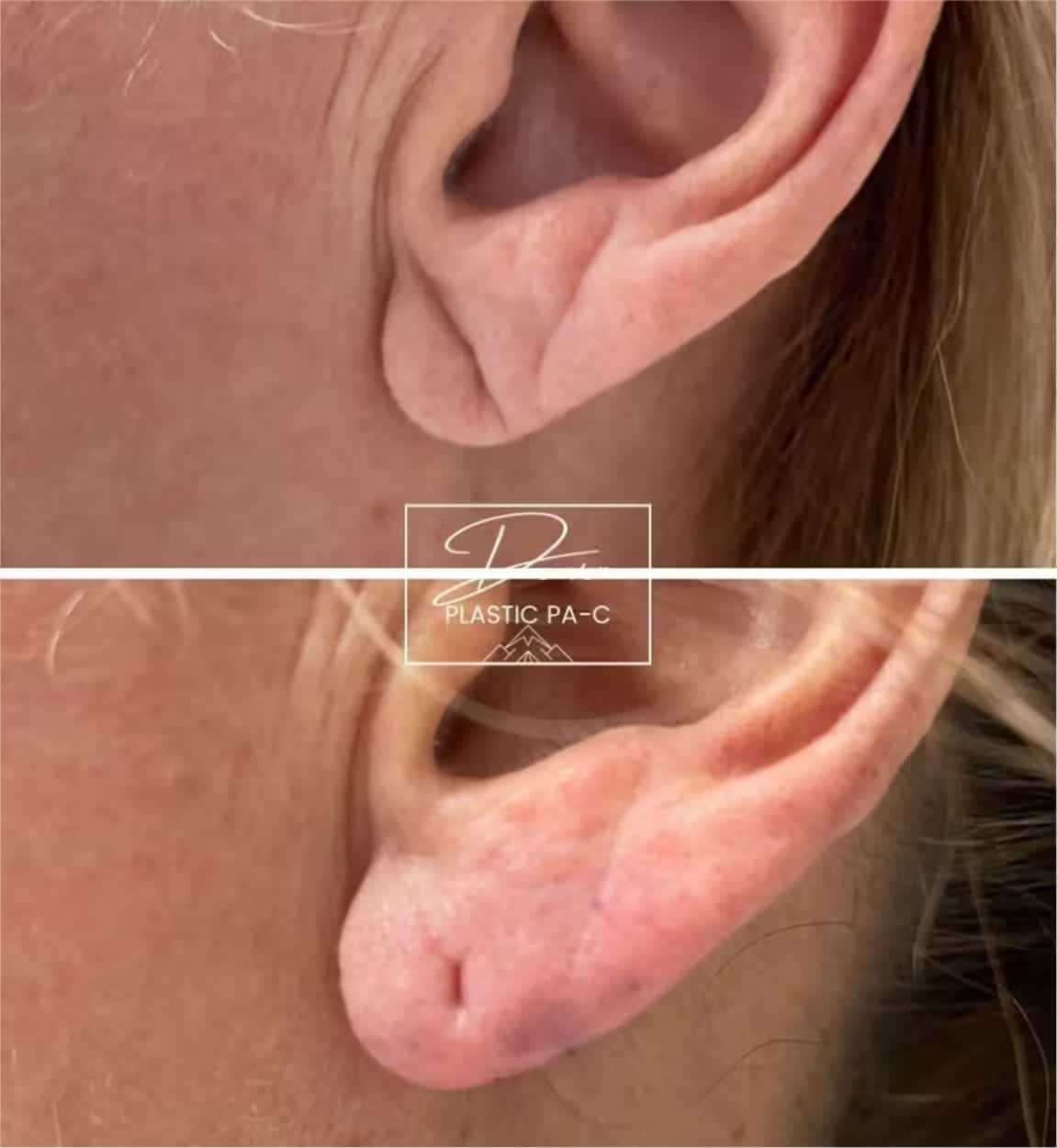 Before and After Image: Earlobe Repair Gallery - left-side