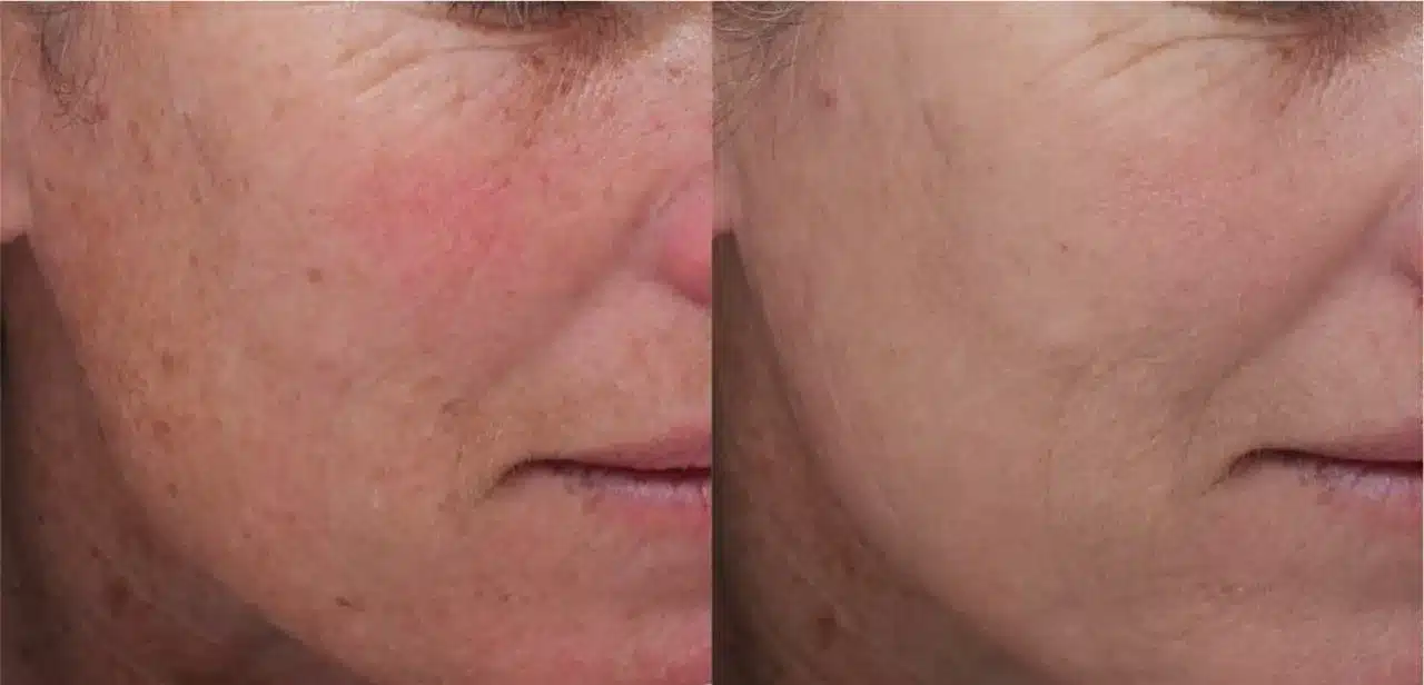 Before and After Image: Moxi Laser - right-front-oblique