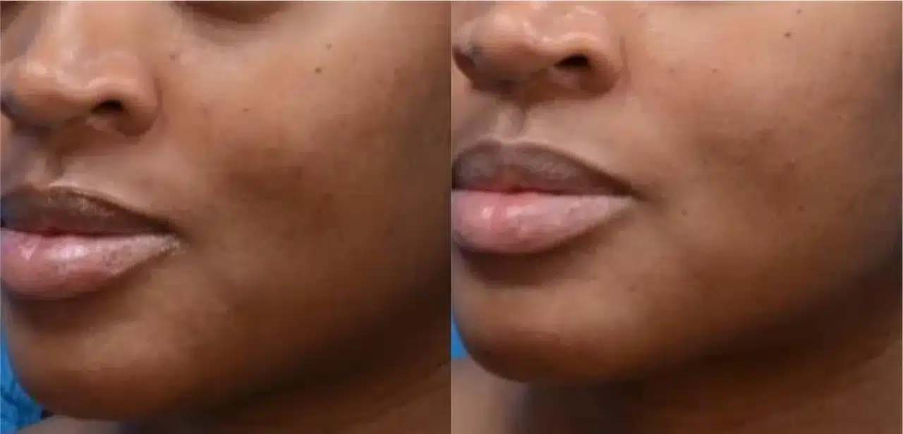 Before and After Image: Moxi Laser - left-front-oblique