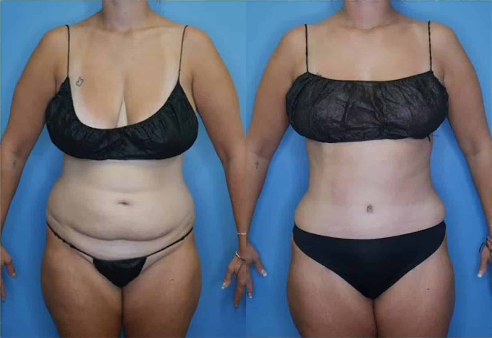 Before and After Image: Mommy Makeover - front