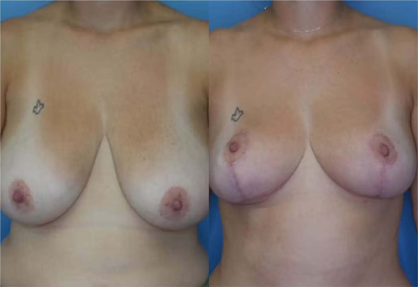 Before and After Image: Mommy Makeover - front