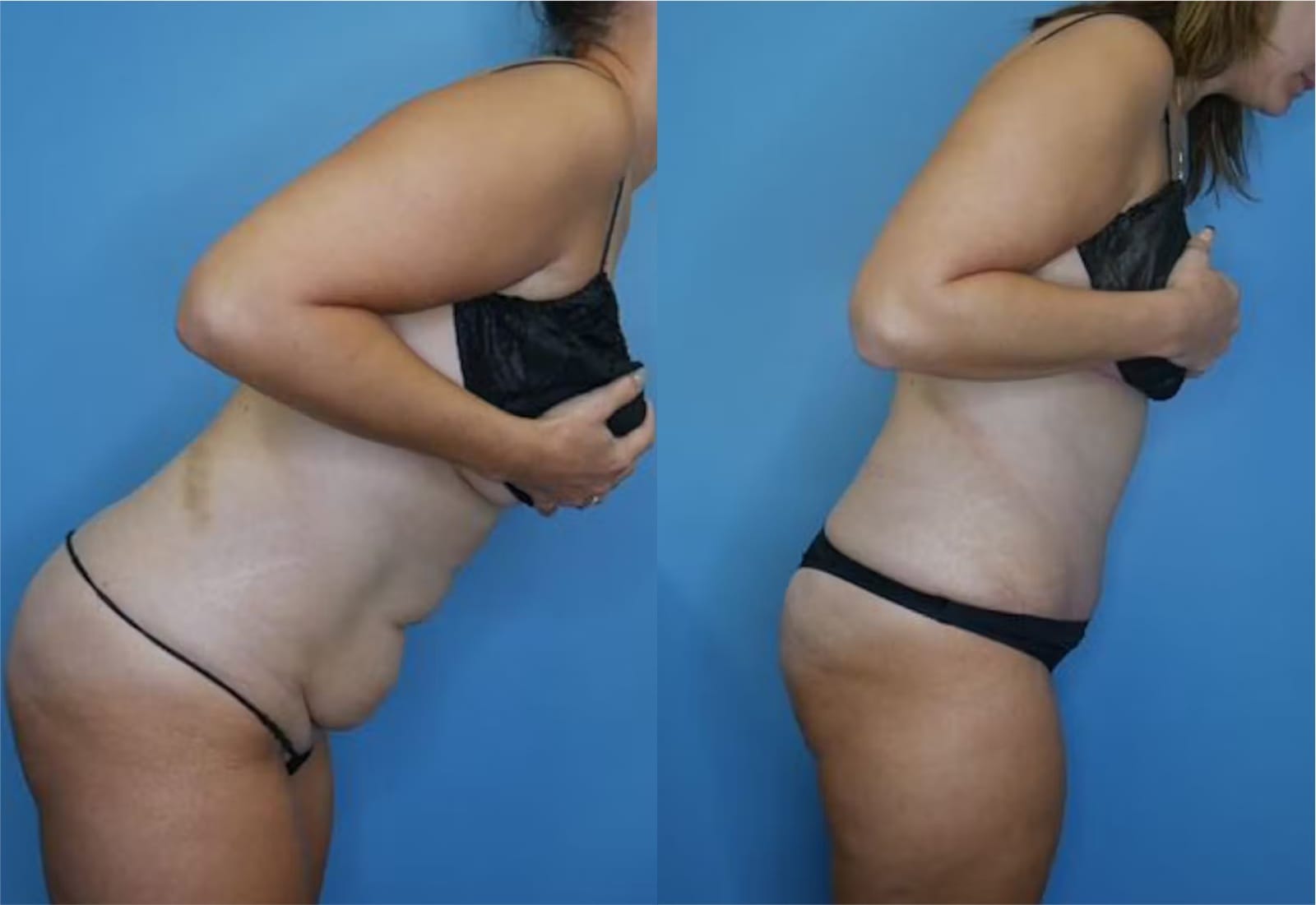 Before and After Image: Mommy Makeover - right-side