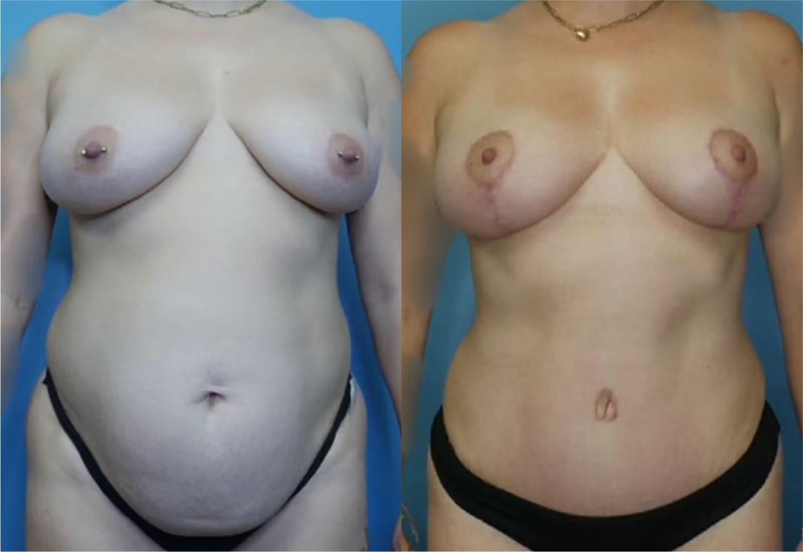 Before and After Image: Mommy Makeover - front